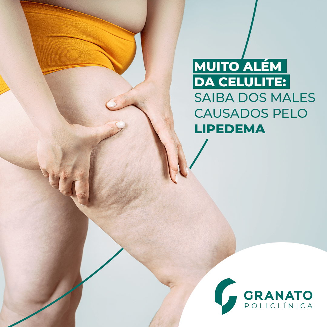 Você já ouvir falar em lipedema?